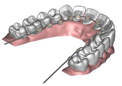 Lingual Braces